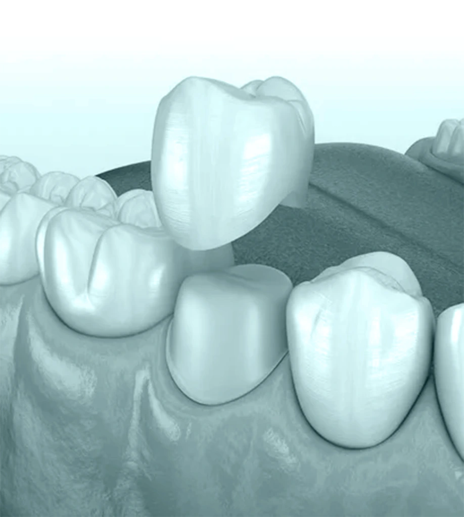 3d image of inside mouth and a dental crown