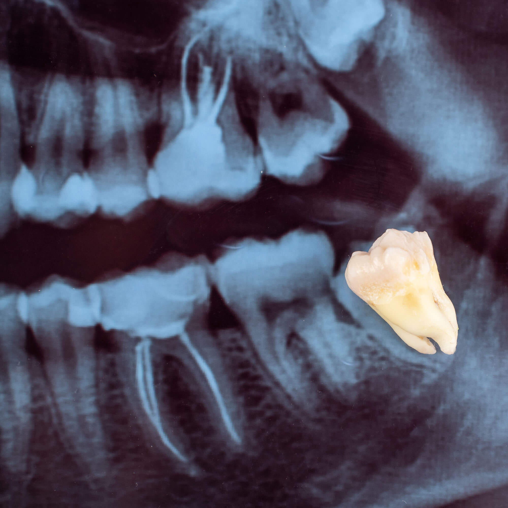 xray of a misaligned wisdom tooth